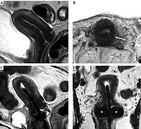 Magnetic resonance imaging in cervical cancer interventional radiotherapy (brachytherapy): 
a pictorial essay focused on radiologist management