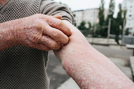 Skuteczność biologicznego leczenia łuszczycy może zwiększyć sam pacjent